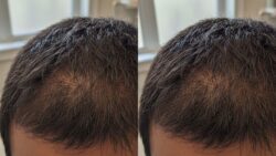 An Expert Helped Fix My Thinning Hair Here’s What Worked Plus the 13 Best Products for 2026