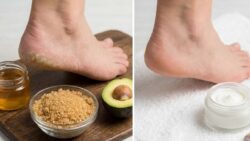 Heal Dry Cracked Heels Faster at Home Using Powerful Kitchen Ingredients That Actually Work