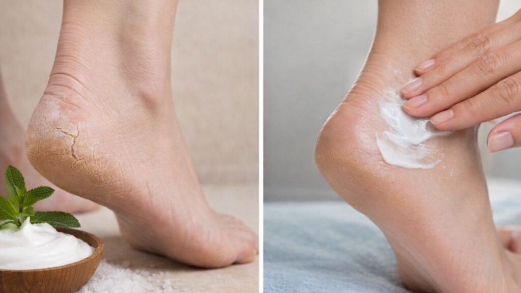 Repair Dry Cracked Heels